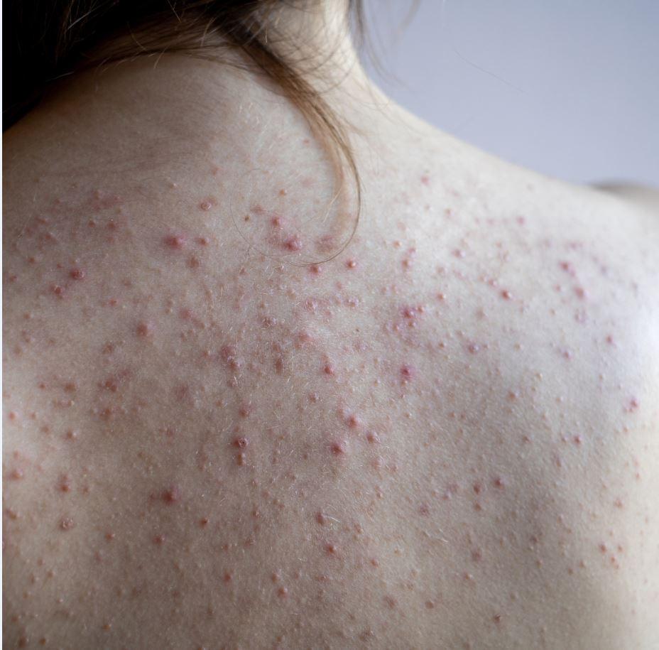 Espinhas nas costas: conheça fatores que contribuem para acnes nessa área do corpo